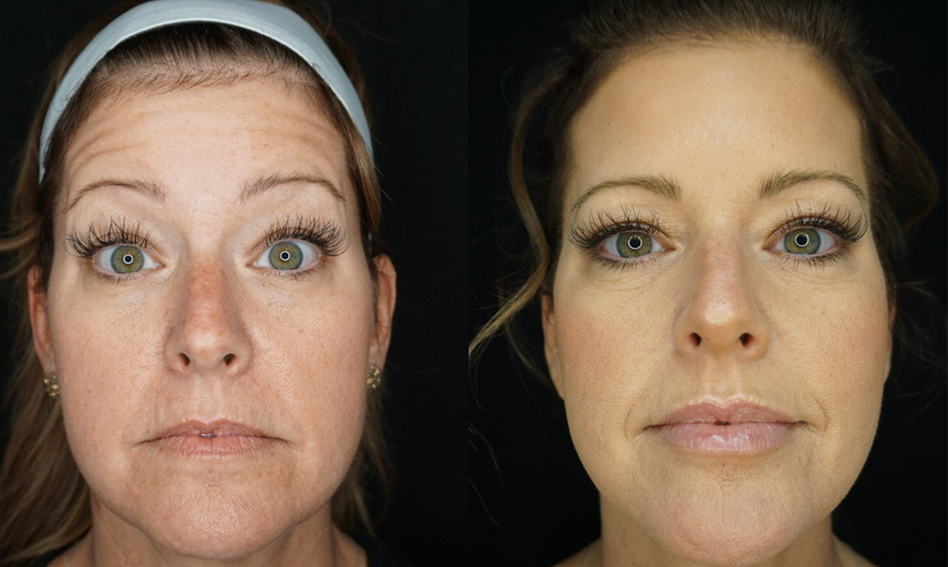 Botox Before & After