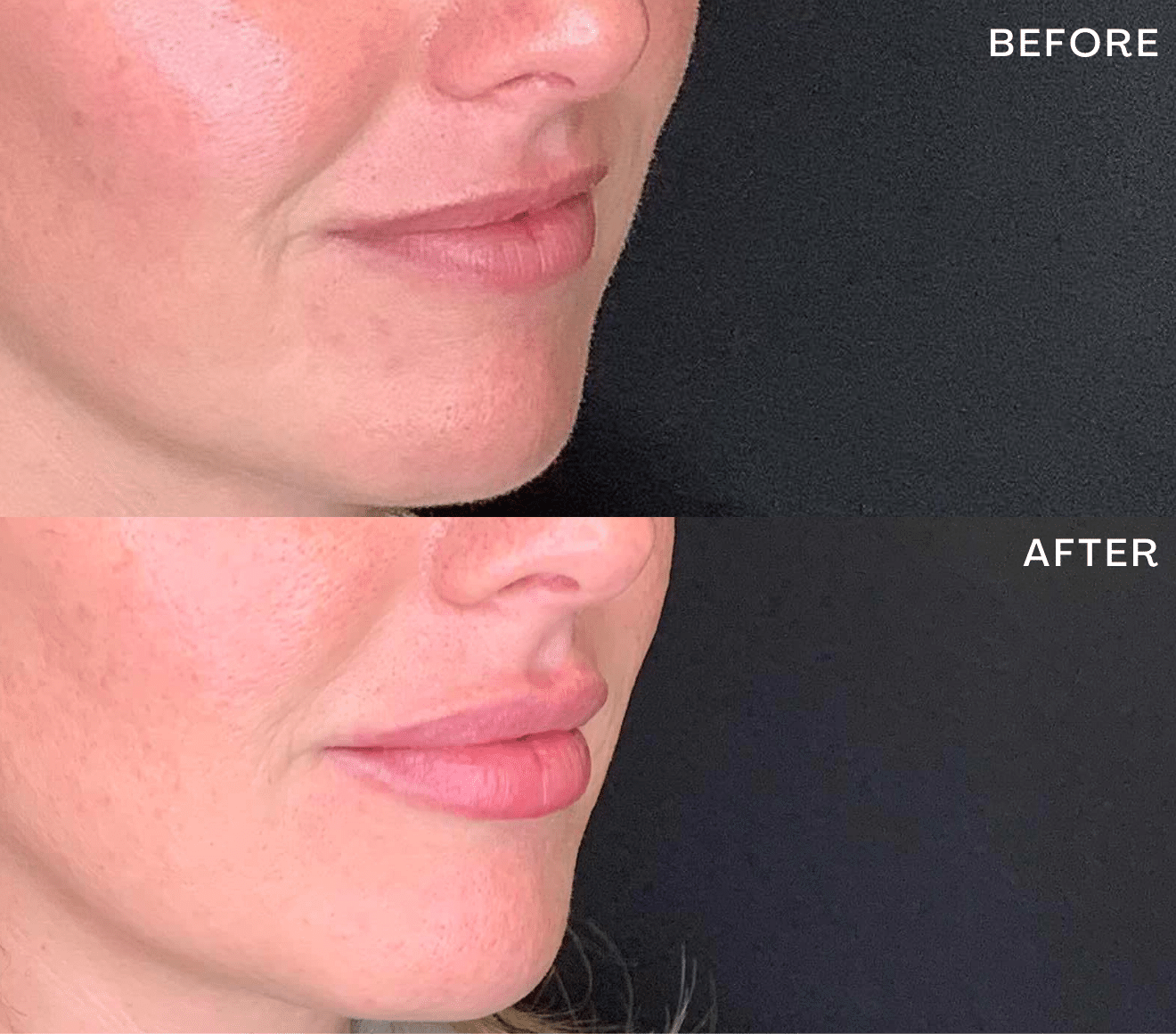 Dermal Fillers Before & After